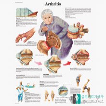 3B Scientific 관절염 인체해부차트 VR1123 Arthritis 관절염차트_액자없음