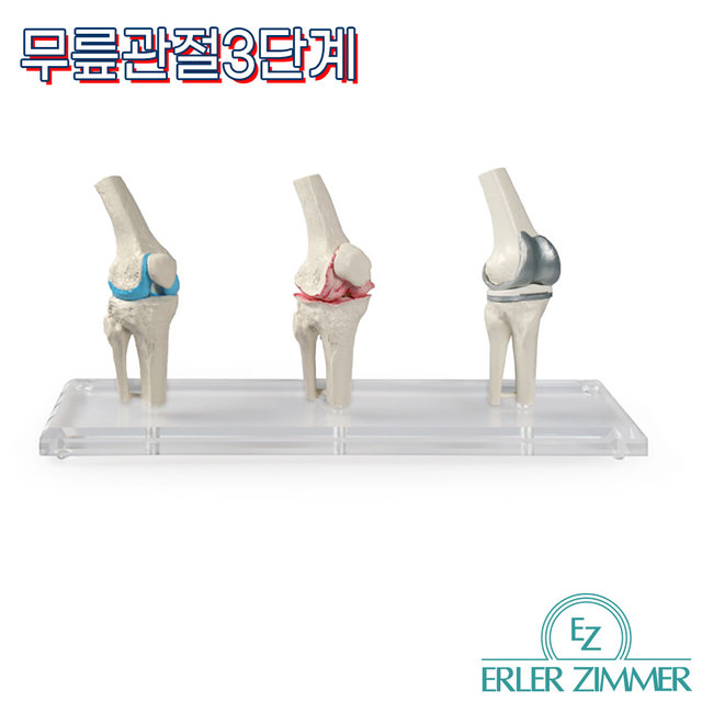 ERLER ZIMMER 인체모형 1125 무릎임플란트 3단계 무릎인공관절